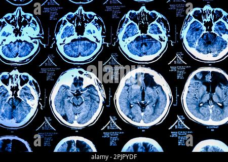Nahaufnahme des CT-Scans mit Gehirn. Medizin, Wissenschaft und Ausbildung MRT-Hirnhintergrund. Magnetresonanztomographie. Tomographie-Aufnahme. Stockfoto