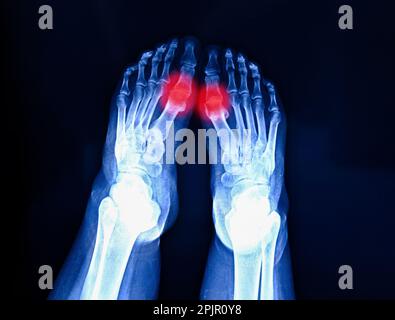 Film Röntgenaufnahme des Fußes zeigt den Schmerzbereich rot, isoliert auf dunklem Hintergrund. Schuhverschleiß und kosmetische Probleme. Stockfoto