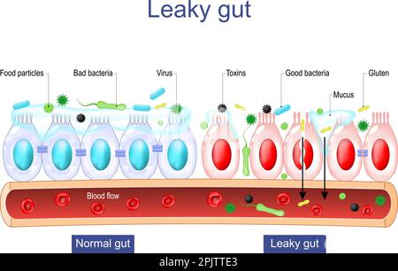 Leck-Darm-Syndrom. Unterschied zwischen gesunden Zellen und entzündeten Darmzellen. Vergleich normaler Gewebe des Gastrointestinaltraktes Stock Vektor