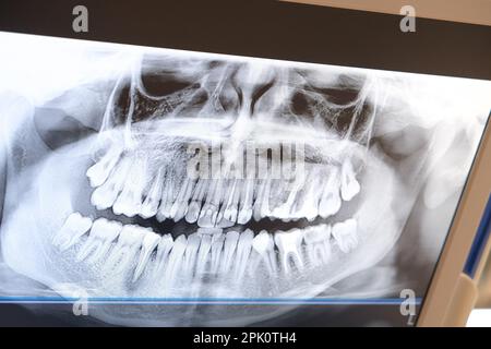 Nahaufnahme der Zahnröntgenuntersuchung am digitalen Bildschirm der Zahnarztklinik. Eine Probe von Zahnrontgen. Selektiver Fokus des Bereichs. Stockfoto