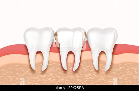 Infiziertes Zahnfleisch und Zahn, Illustration. Parodontopathie Stockfoto