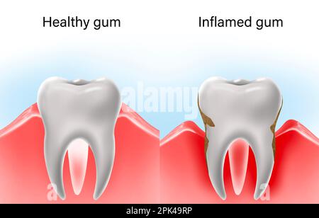 Collage mit Illustrationen von gesunden und kranken Zähnen. Gingivitis und Parodontitis Stockfoto