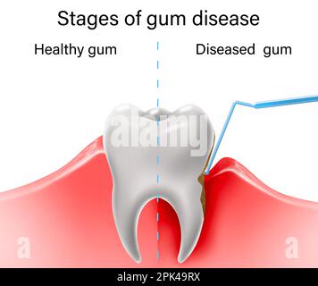 Collage mit Illustrationen von gesunden und kranken Zähnen. Gingivitis und Parodontitis Stockfoto