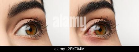 Collage mit Fotos einer Frau mit entzündeten und gesunden Augen vor und nach der Behandlung, Nahaufnahme. Bannerdesign Stockfoto