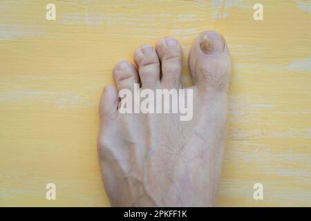 Zehennägel mit Pilzproblemen, Onychomykose, auch bekannt als Tinea unguium, ist eine Pilzinfektion des Nagels, grüner Hintergrund. Stockfoto