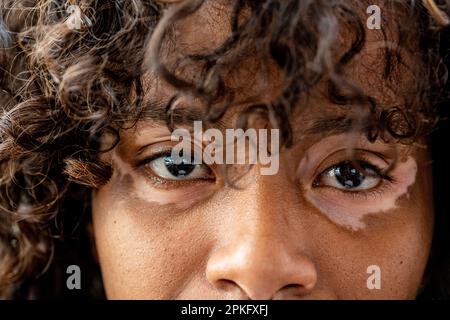 Porträt einer jungen brasilianischen Frau mit Vitiligo auf Gesicht und Augenkontur, Nahaufnahme von Haut-, Augen- und Lockenhaaren, Kopierraum Stockfoto