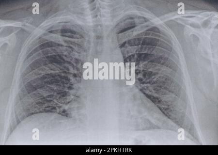 Fluorographisches Bild der Lungen auf Papier Nahaufnahme, gesunde Lungen eines Mannes für eine Routineuntersuchung, Gesundheit Stockfoto