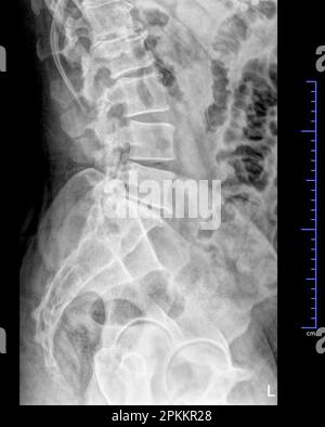 Röntgenaufnahme des Beckens und der Wirbelsäule, Seitenansicht Stockfoto