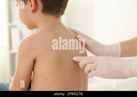 Doktor untersucht kleinen Jungen mit Windpocken in der Klinik, Nahaufnahme. Varicella-Zoster-Virus Stockfoto