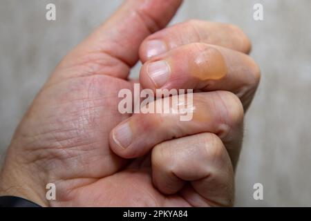 Typische Hautblasen bei Verbrennungen durch kochendes Öl zweiten Grades. Stockfoto