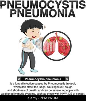 Informationsposter zur Illustration der Pneumocystis-Pneumonie Stock Vektor