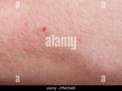 Allergischer Hautausschlag Dermatitis Hautstruktur Stockfoto