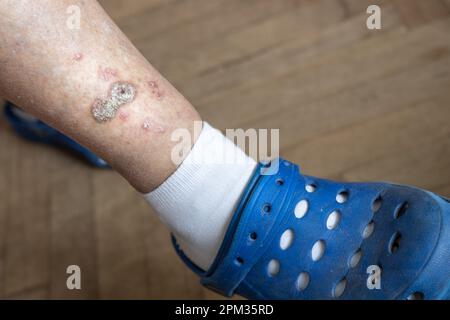 Geschwüre und Hautkrankheiten, getrocknete Schorf und frische Wunden an den Beinen einer älteren Frau, Gesundheitskonzept, senile Veränderungen, Nahaufnahme Stockfoto