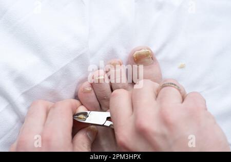 Männlich geschnittene Nägel mit Nagelpilz. Pilzinfektion an Nagelbeinen, Finger mit Onychomykose. Pflege und Behandlung. Nahaufnahme eines Fußes mit beschädigten Nägeln b Stockfoto