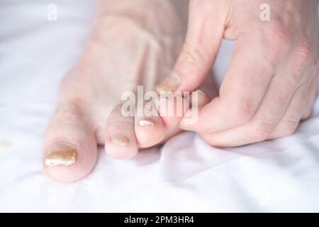 Männlich geschnittene Nägel mit Nagelpilz. Pilzinfektion an Nagelbeinen, Finger mit Onychomykose. Pflege und Behandlung. Nahaufnahme eines Fußes mit beschädigten Nägeln b Stockfoto