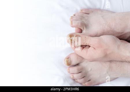 Männlich geschnittene Nägel mit Nagelpilz. Pilzinfektion an Nagelbeinen, Finger mit Onychomykose. Pflege und Behandlung. Nahaufnahme eines Fußes mit beschädigten Nägeln b Stockfoto