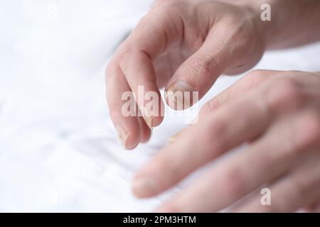 Männlich geschnittene Nägel mit Nagelpilz. Pilzinfektion an Händen, Beinen, Finger mit Onychomykose. Pflege und Behandlung. Nahaufnahme eines Fußes mit beschädigten Nägeln b Stockfoto