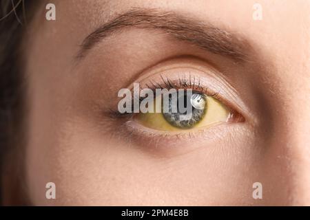 Junge Frau mit gelben Augen, Nahaufnahme. Hepatitis-Symptom Stockfoto