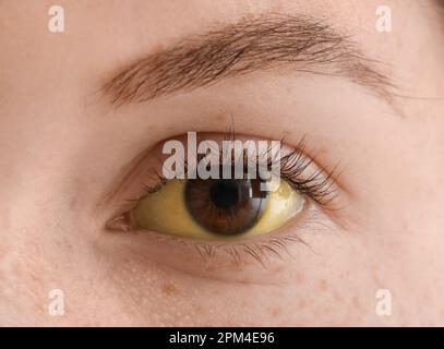 Junge Frau mit gelben Augen, Nahaufnahme. Hepatitis-Symptom Stockfoto