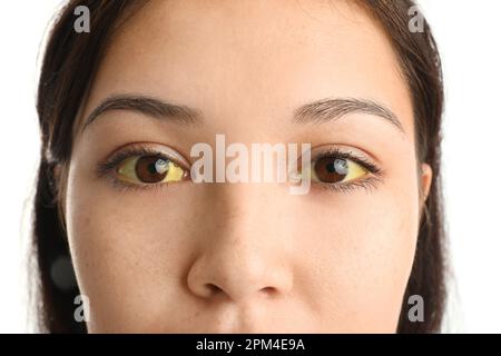 Junge Frau mit gelben Augen, Nahaufnahme. Hepatitis-Symptom Stockfoto