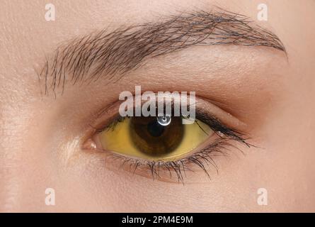 Junge Frau mit gelben Augen, Nahaufnahme. Hepatitis-Symptom Stockfoto