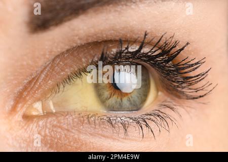 Junge Frau mit gelben Augen, Nahaufnahme. Hepatitis-Symptom Stockfoto