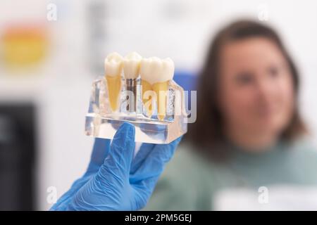 Nahaufnahme des zahnärztlichen Implantat-Behandlungsplans. Der Fokus liegt auf dem Zahnimplantatmodell in der Hand des Zahnarztes Stockfoto
