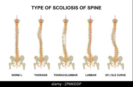 Medizinisches Poster zur Darstellung von Skolioseformen auf weißem Hintergrund. Illustration einer gesunden und erkrankten Wirbelsäule Stockfoto