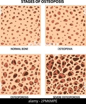 Stadien der Osteoposis-Vektordarstellung Stock Vektor