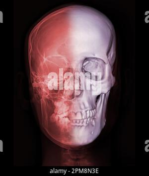 Röntgenbild des menschlichen Schädels Vorderansicht mit 3D-Rendering zur Diagnose einer Schädelfraktur isoliert auf schwarzem Hintergrund. Stockfoto