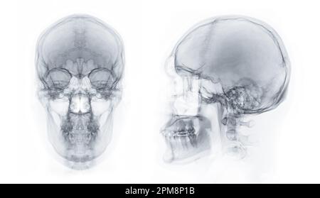 Röntgenbild des menschlichen Schädels in AP- und Lateralansicht zur Diagnose einer Schädelfraktur isoliert auf schwarzem Hintergrund. Stockfoto