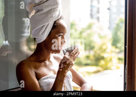 Porträt einer jungen brasilianischen Frau mit Vitiligo auf Gesicht und Händen, Hautpflege und medizinischem Konzept Stockfoto