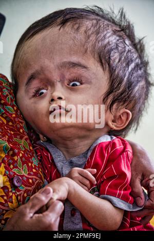 Hydrozephalus-Kinder, Semarang, Java, Indonesien, Asien Stockfoto