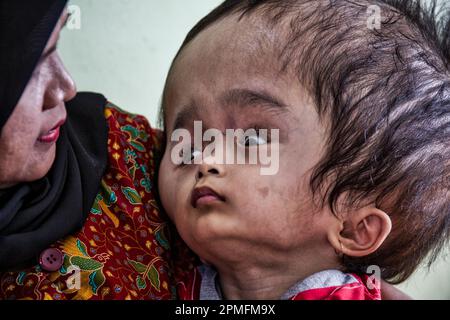 Hydrozephalus-Kinder, Semarang, Java, Indonesien, Asien Stockfoto