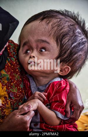 Hydrozephalus-Kinder, Semarang, Java, Indonesien, Asien Stockfoto