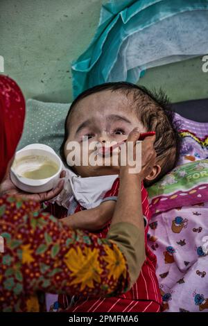 Hydrozephalus-Kinder, Semarang, Java, Indonesien, Asien Stockfoto