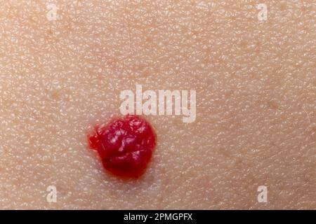 Rotes Muttermal auf der Haut, extreme Nahaufnahme, Makro Stockfoto
