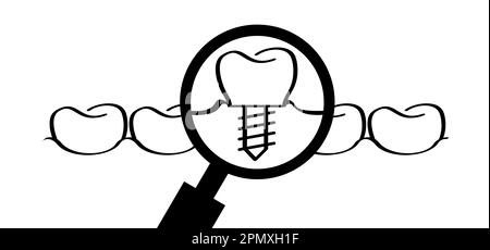 Zahnimplantat, medizinisch korrekt oder Zahnbrücke. Cartoon gesund, Zahn mit Zahnfleisch. Molares Linienmuster. Zahn mit Schraube ziehen. Beschädigte Zähne oder t Stockfoto