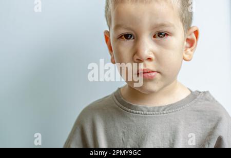 Ein kleines Kind mit verdorbenen Augen leidet an Konjunktivitis.Nahaufnahme eines schweren blutunterlaufenen Auges.London England Stockfoto