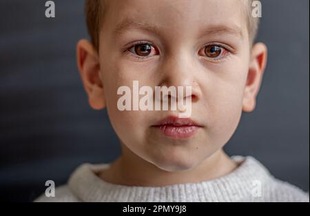 Ein kleines Kind mit verdorbenen Augen leidet an Konjunktivitis.Nahaufnahme eines schweren blutunterlaufenen Auges.London England Stockfoto