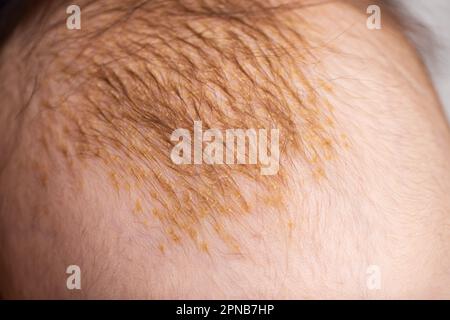 Der Entstehungsvorgang der seborrhoischen Dermatitis bei einem Säugling am Kopf. Schuppige Krusten. Stockfoto