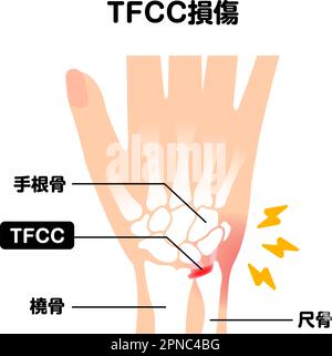 Über TFCC-Verletzungen. Vektordarstellung Stock Vektor