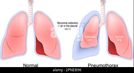 Pneumothorax. Luftansammlung zwischen Lunge und Brusthöhle. Normale und kollabierte Lungen. Human Respiratory System (menschliches Atmungssystem). Vektordarstellung Stock Vektor