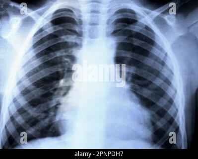 Nahaufnahme des Thoraxröntgenbildes. Thoraxröntgenuntersuchung zur Diagnostik von Lungenerkrankungen. Röntgen von Organen bei erwachsenen Männern, ärztliche Untersuchung Stockfoto