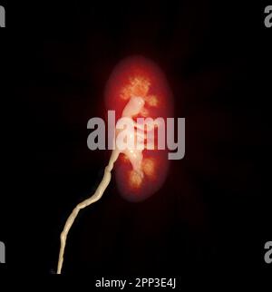 CTA-Nierenarterie mit 3D-Rendering-Bild der Niere. Stockfoto