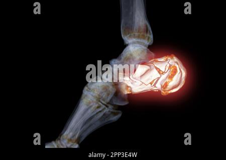 CT-Scan des Sprunggelenks mit 3D-Darstellung des Fersenbeins mit Fersenbeinfrakturen. Stockfoto