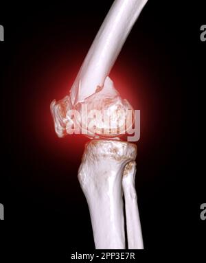 CT-Scan des Kniegelenkes mit 3D-Rendering-Darstellung der Fraktur des distalen Femurknochens. Stockfoto