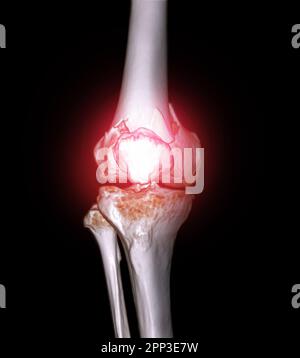 CT-Scan des Kniegelenkes mit 3D-Rendering-Darstellung der Fraktur des distalen Femurknochens. Stockfoto