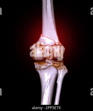 CT-Scan des Kniegelenkes mit 3D-Rendering-Darstellung der Fraktur des distalen Femurknochens. Stockfoto