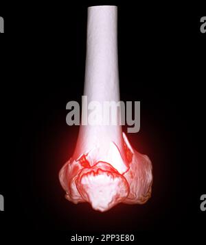 CT-Scan des Kniegelenkes mit 3D-Rendering-Darstellung der Fraktur des distalen Femurknochens. Stockfoto